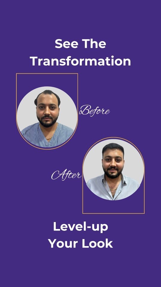 Hair Transplant in Ahmedabad, Gujarat results with visible reduction in baldness and improved density