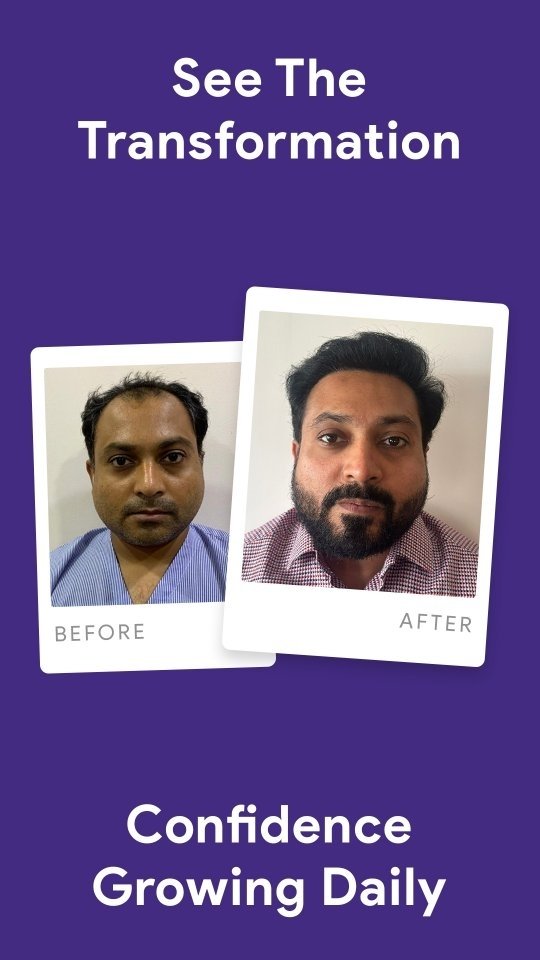 Hair Transplant in Ahmedabad, Gujarat before and after comparison showing full hairline restoration