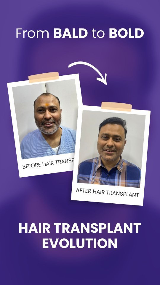 Affordable Hair Transplant in Ahmedabad, Gujarat before and after results with natural hairline