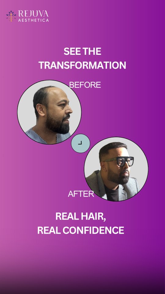 Hair Transplant in Ahmedabad, Gujarat transformation with dense hair growth after treatment