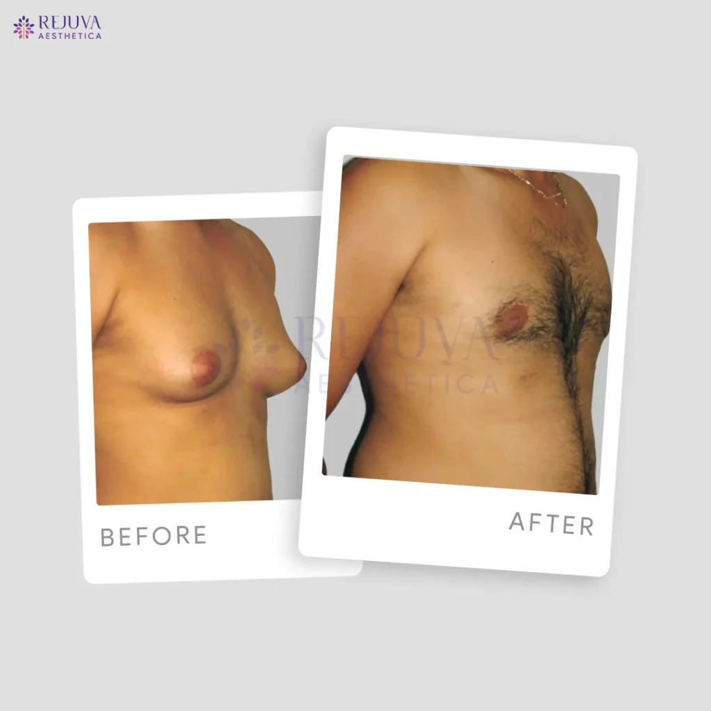 Is Gynecomastia Surgery Covered by Insurance in India? 2026 Guide by Dr. Arth Shah, Top Gynecomastia Surgeon in Ahmedabad