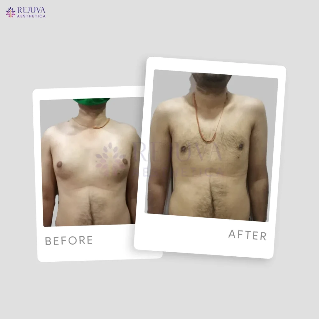 Best Gynecomastia Surgeon in Ahmedabad: Why Dr. Arth Shah at Rejuva Aesthetica is the Top Choice for Male Breast Reduction (2026 Update)